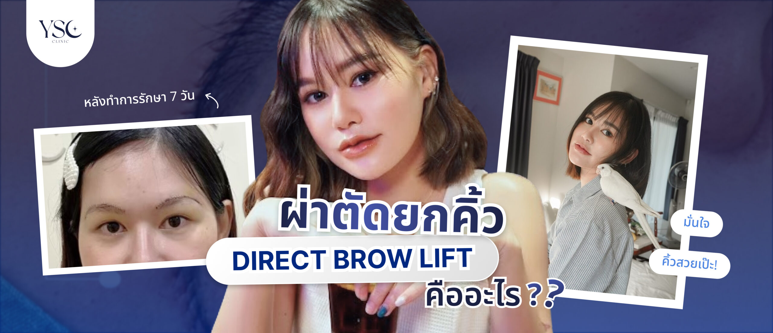 ผ่าตัดยกคิ้ว (direct brow lift)