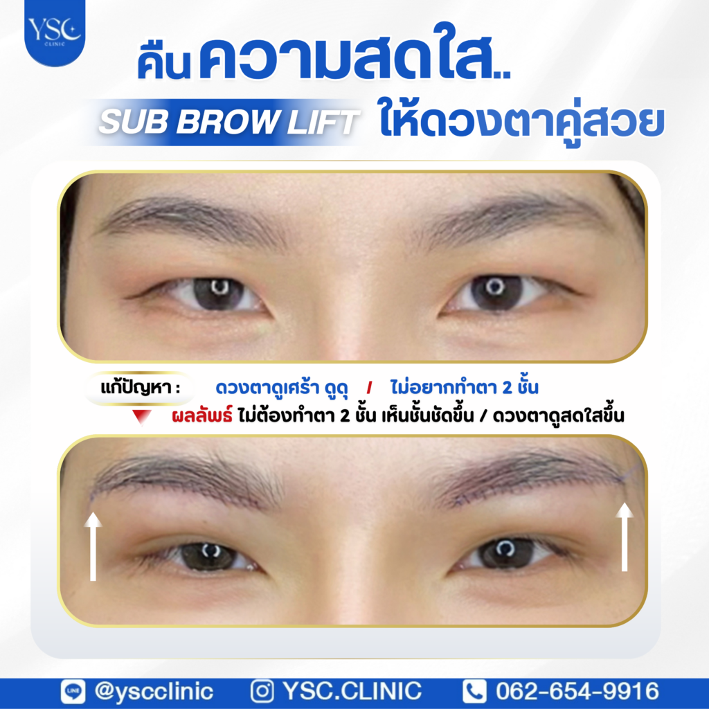 ผ่าตัดกระชับหนังตา (sub brow lift)