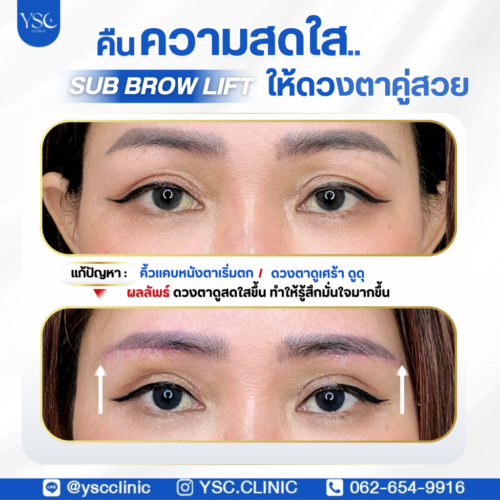 ผ่าตัดกระชับหนังตา (sub brow lift)