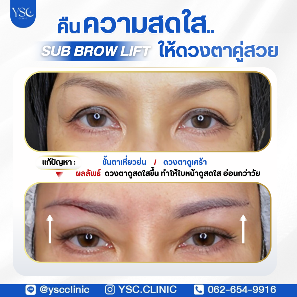 ผ่าตัดกระชับหนังตา (sub brow lift)